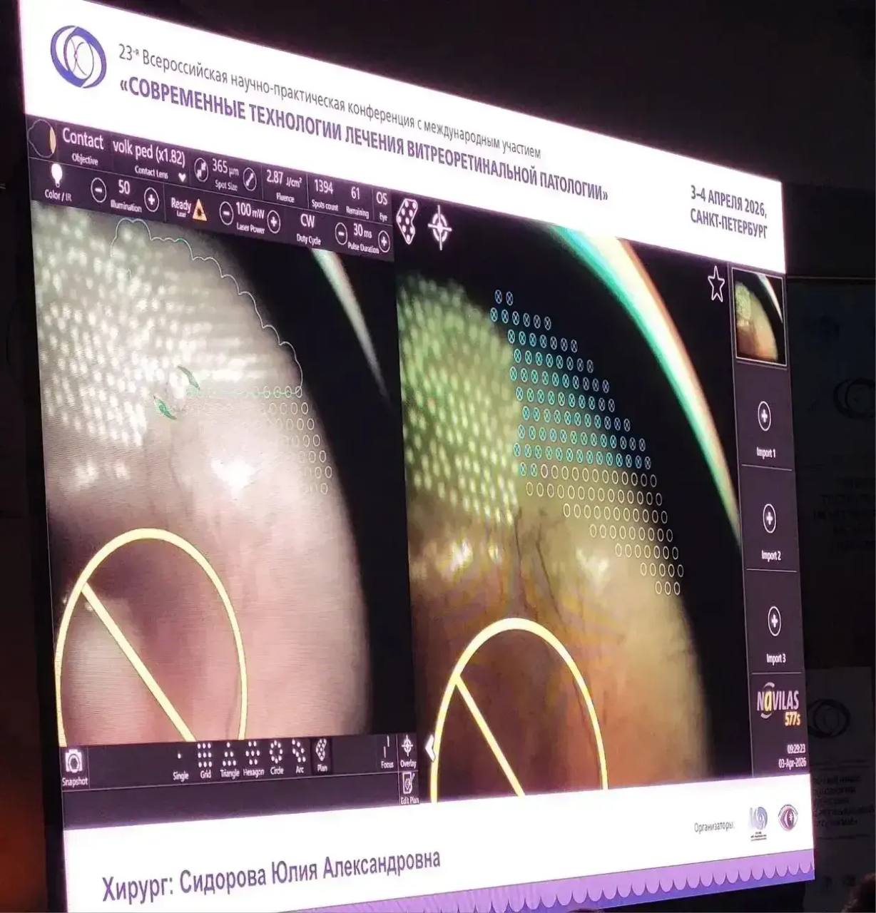 Владислав Шапша: Офтальмологи калужского филиала МНТК им. Фёдорова провели уникальную операцию в прямом эфире и спасли зрение новорожденной девочке из Курской области Владислав Шапша: Офтальмологи калужского филиала МНТК им. Фёдорова провели уникальную операцию в прямом эфире и спасли зрение новорожденной девочке из Курской области