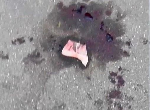 Бретельками лифчика девушки спасли пострадавшего в поножовщине в Обнинске Бретельками лифчика девушки спасли пострадавшего в поножовщине в Обнинске